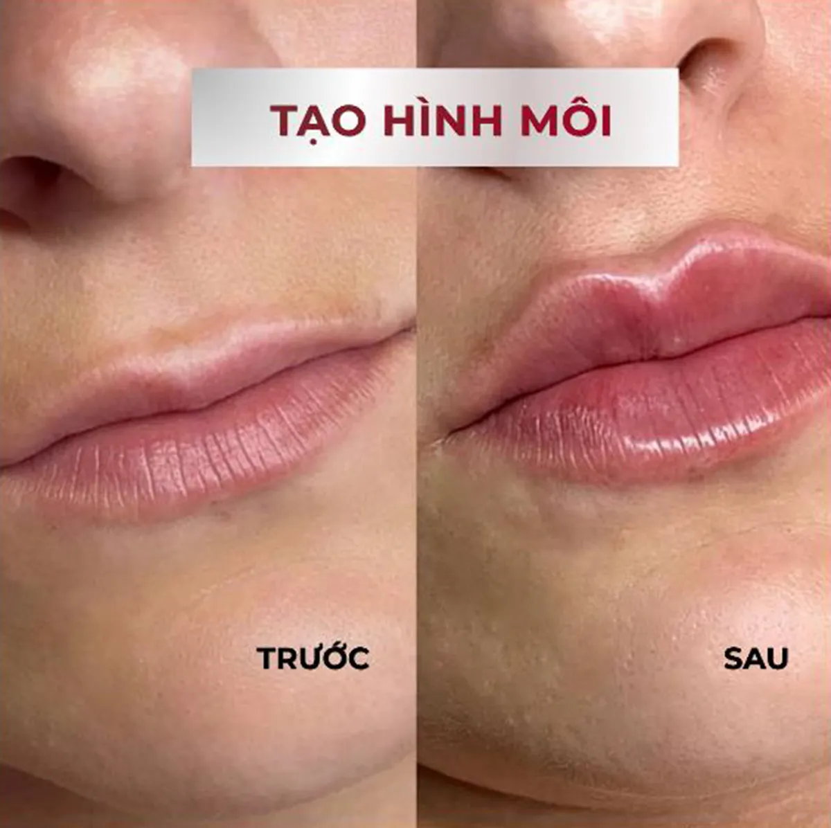 Tạo hình môi với sản phẩm filler RICHESSE Soft