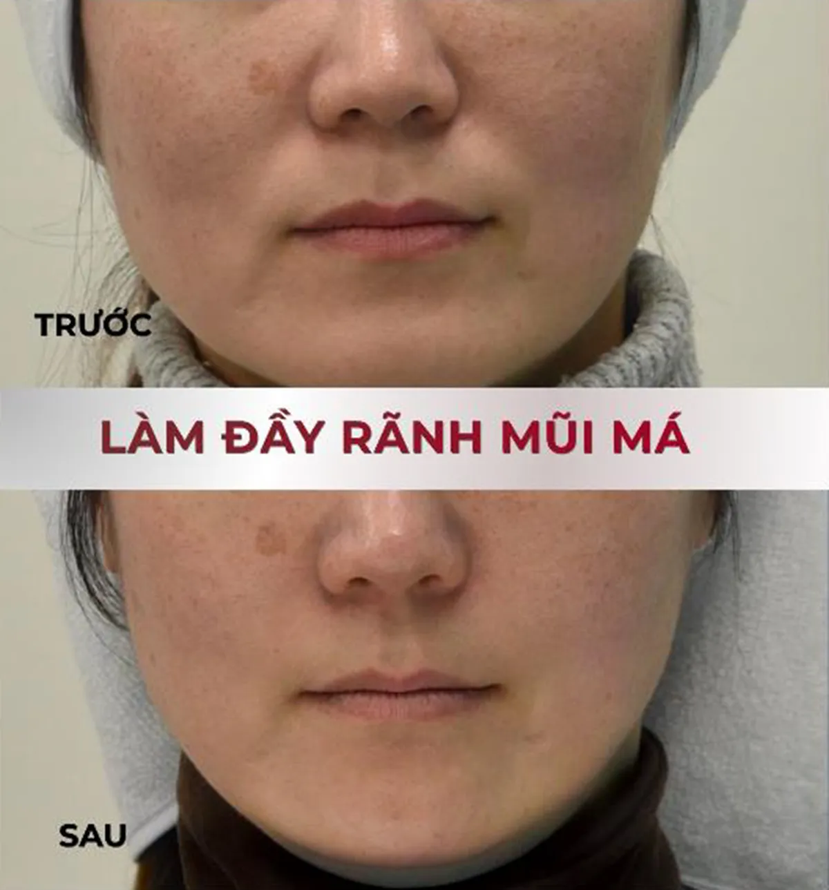 Làm đầy rãnh mũi má với sản phẩm filler RICHESSE Deep