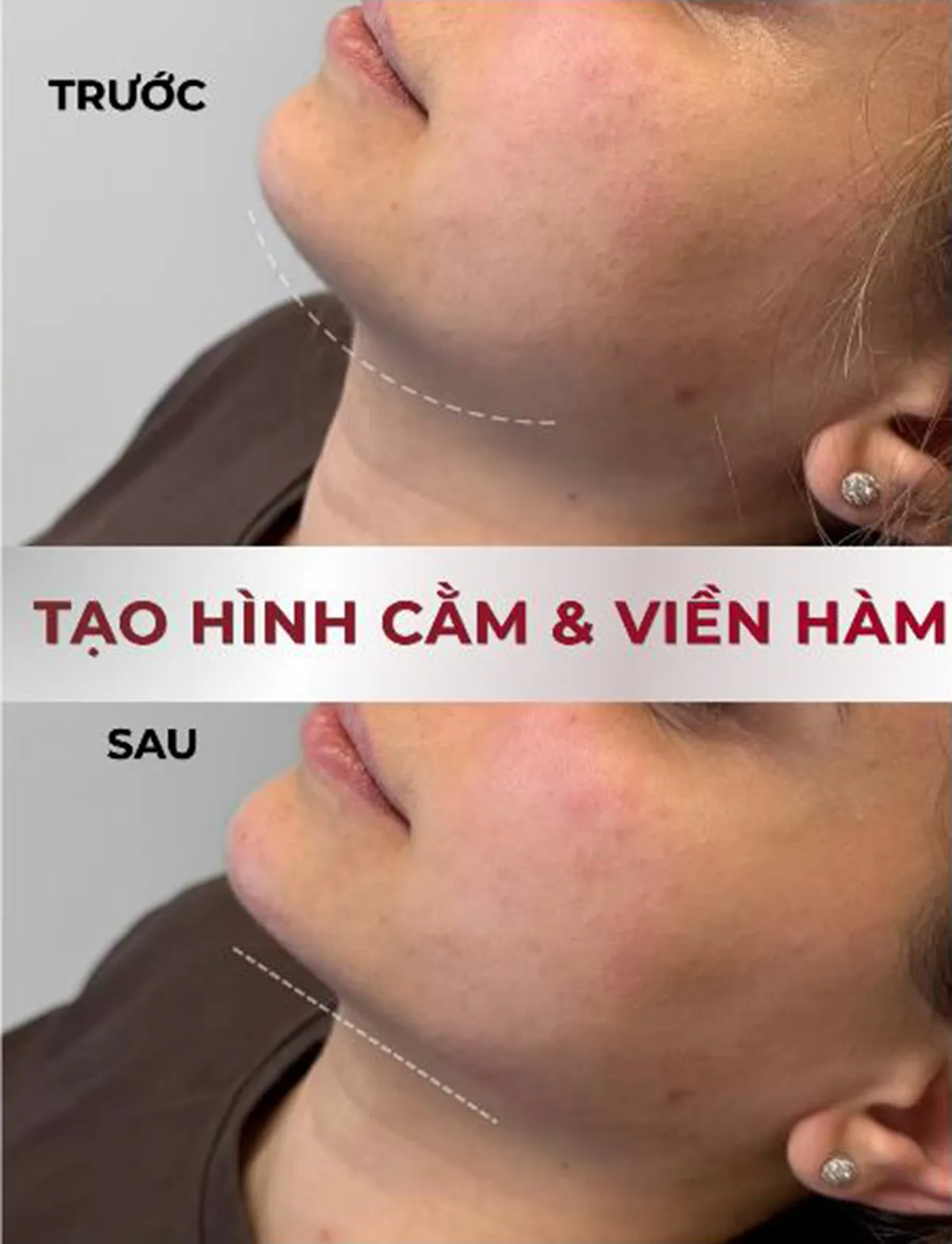 Tạo hình cằm và đường viền hàm với sản phẩm filler RICHESSE Implant