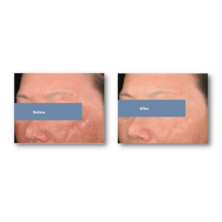 /storage/product/7/Md_Tranex-Retipeel-Thay-da-sinh-hoc-tri-nam-sang-da-Chong-lao-hoa-oscar-medical-2.jpeg