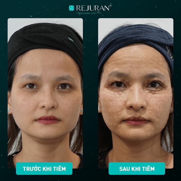 /storage/product/7/Rejuran-Lieu-trinh-lam-dep-quoc.jpg