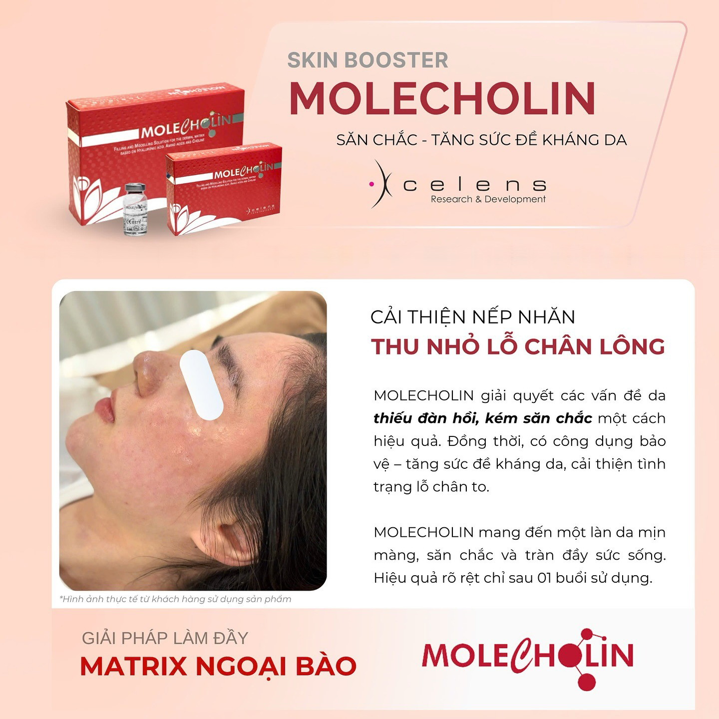 /storage/product/7/xcelens-molecholin-thu-nho-lo-chan-long.jpg